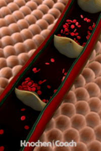 Osteoporose Arteriosklerose